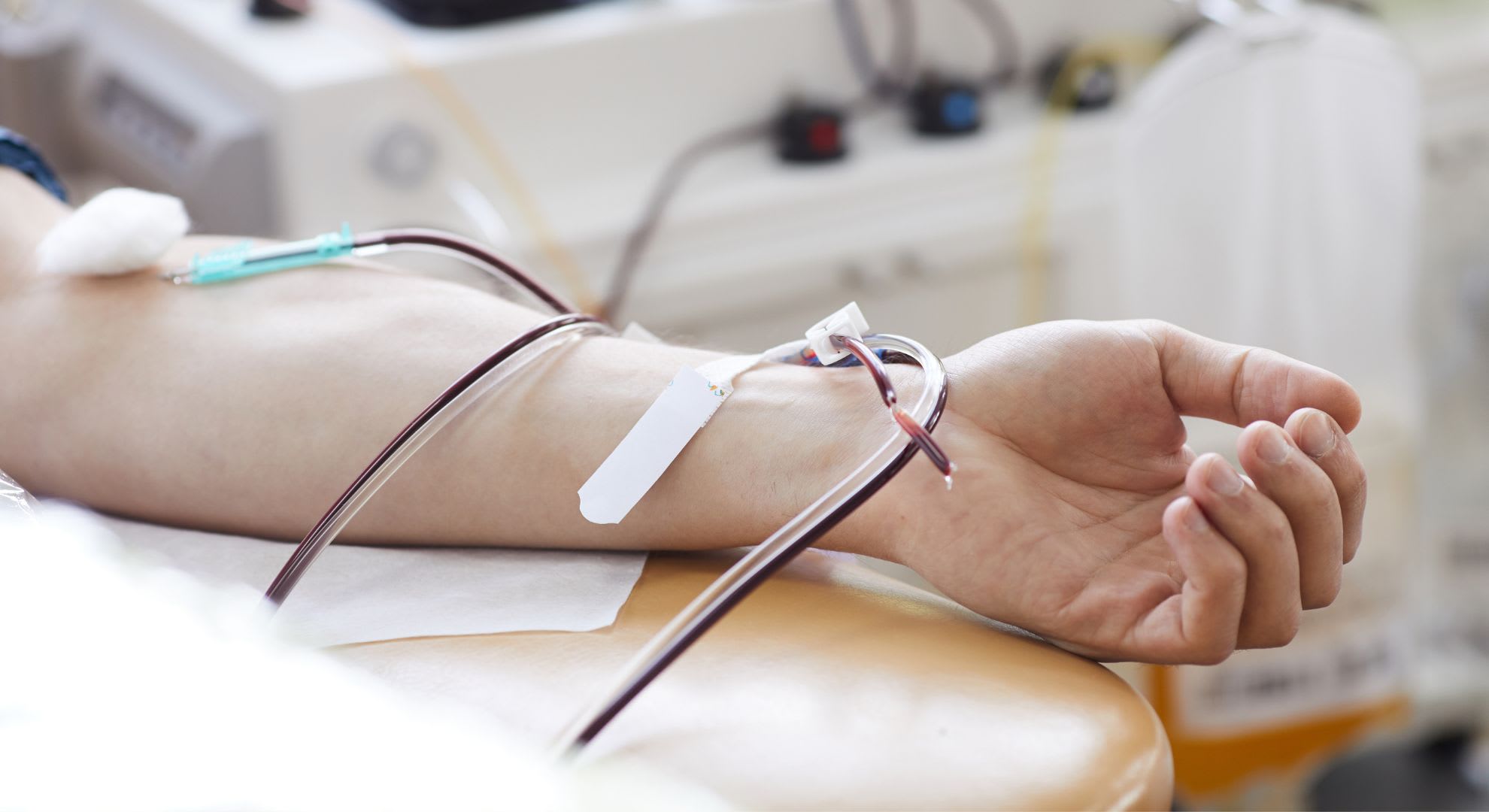 A person’s arm with a needle inserted and blood flowing through a tube, possibly during 10 pass ozone therapy, a medical procedure known for its potential benefits.